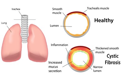 Analysis of Cystic Fibrosis Patients’ Condition using Multichannel Lung Sound Processing